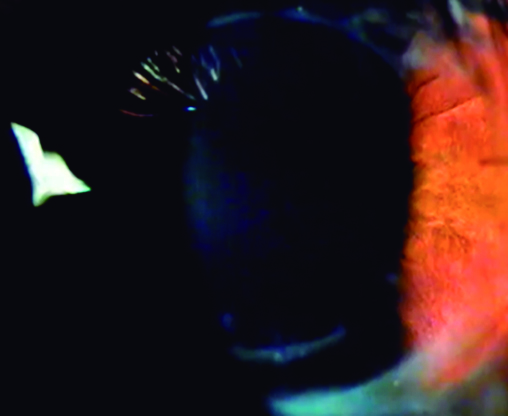 figura1 Incisiones arqueadas realizadas con láser de femtosegundo para corregir el astigmatismo post-queratoplastia