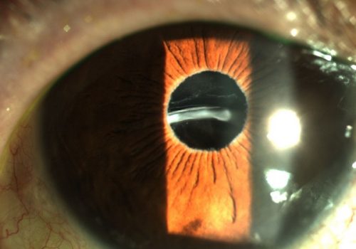 Ojo derecho