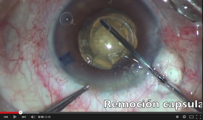 femtosegundo-y-ultrachopper_luis_escaf Artículo Especial: Una técnica alternativa para el manejo de cataratas densas con Femto.