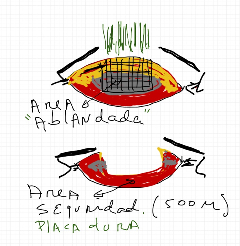 imagen-2 Artículo Especial: Una técnica alternativa para el manejo de cataratas densas con Femto.