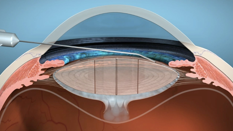 imagen-3 Artículo Especial: Una técnica alternativa para el manejo de cataratas densas con Femto.
