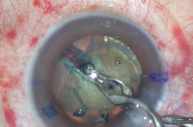 imagen-5 Artículo Especial: Una técnica alternativa para el manejo de cataratas densas con Femto.