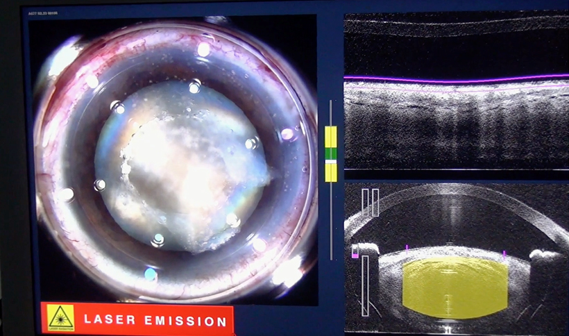 imagen-52 Artículo Especial: Una técnica alternativa para el manejo de cataratas densas con Femto.