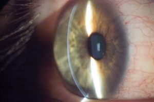 Foto 3-1592300 OD Ectasia en LASIK