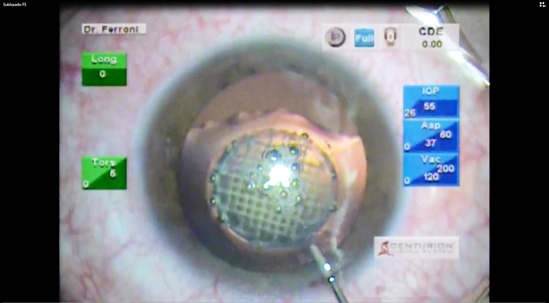 video-caso-cristalino Caso Cristalino: Cirugía de cataratas con Femtosegundo