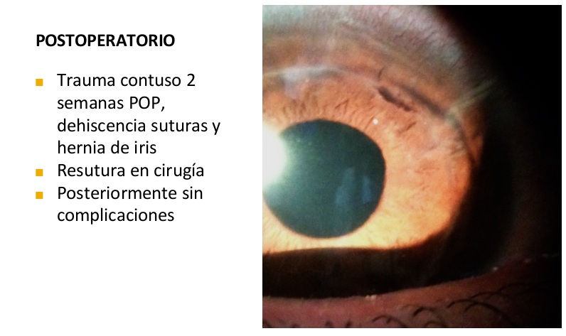 2016-09-19 Caso Córnea: Complicaciones en cirugía de refractiva corneal