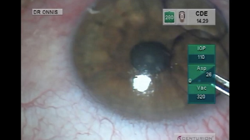 captura-de-pantalla-2016-09-07 Caso Córnea: Complicaciones en cirugía de refractiva corneal