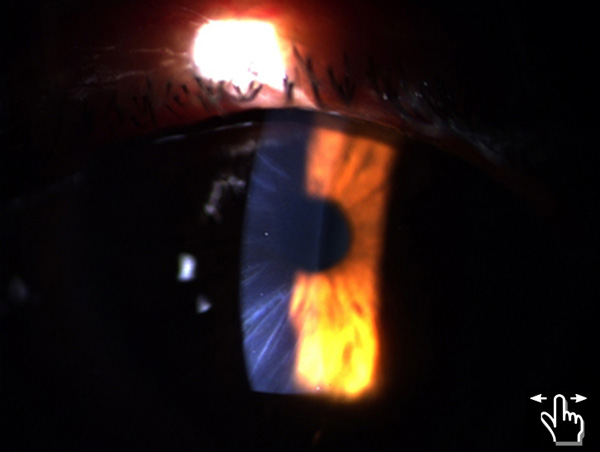 08-1-alaccsa-r-no12-sept-oct-2015 Editorial Córnea-¿How precise is IOL calculation in RK-operated eyes?