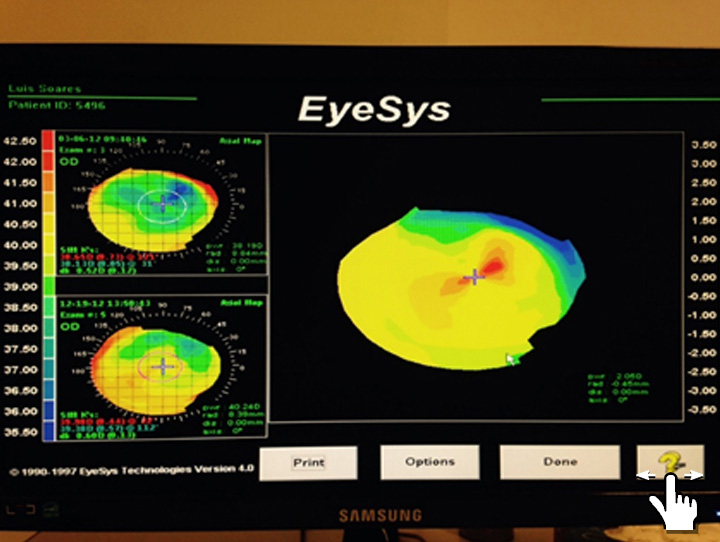 09-1-alaccsa-r-no12-sept-oct-2015 Editorial Córnea-¿How precise is IOL calculation in RK-operated eyes?