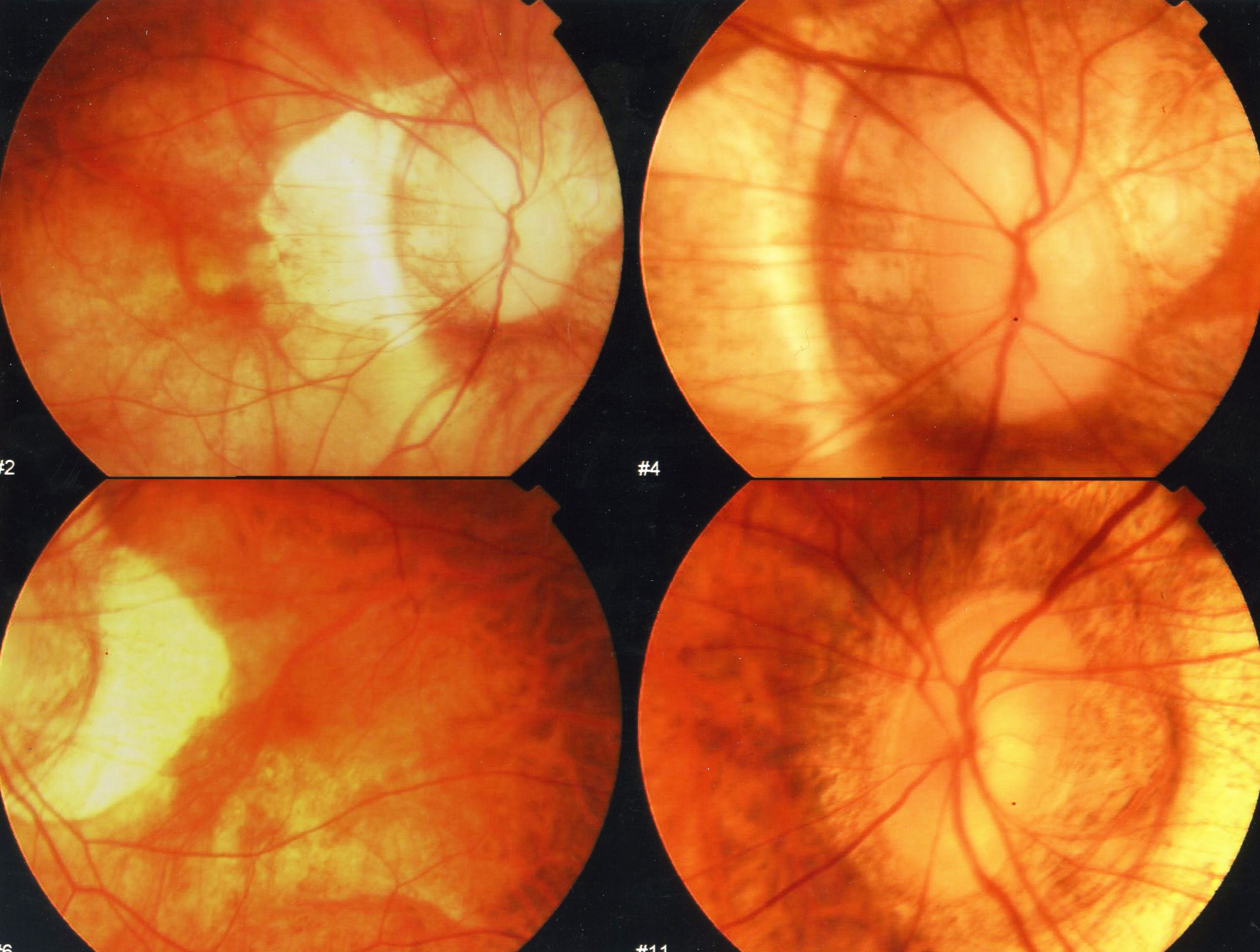 fig-3-foto-de-polo-posterior-od-y-oi Caso Cristalino Resultado refractivo indeseado