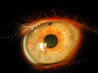 foto-lio-artiflex Caso Cristalino Resultado refractivo indeseado