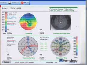 imagen-1 Foro Cristalino Resultado refractivo indeseado