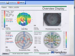 imagen-2 Foro Cristalino Resultado refractivo indeseado