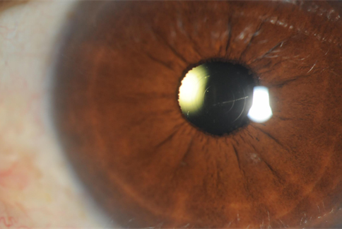imagen-3-lente-intraocular Lo mejor del ASCRS: Cirugía de catarata.