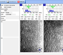imagen-3 Foro Cristalino Resultado refractivo indeseado