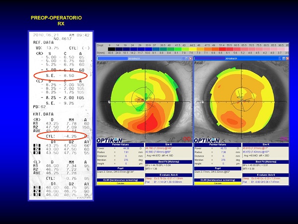 imagen-diapositiva-01 Caso Refractiva Astigmatismo Irregular, Queratocono