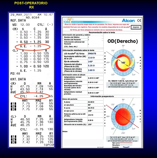 imagen-diapositiva-02 Caso Refractiva Astigmatismo Irregular, Queratocono