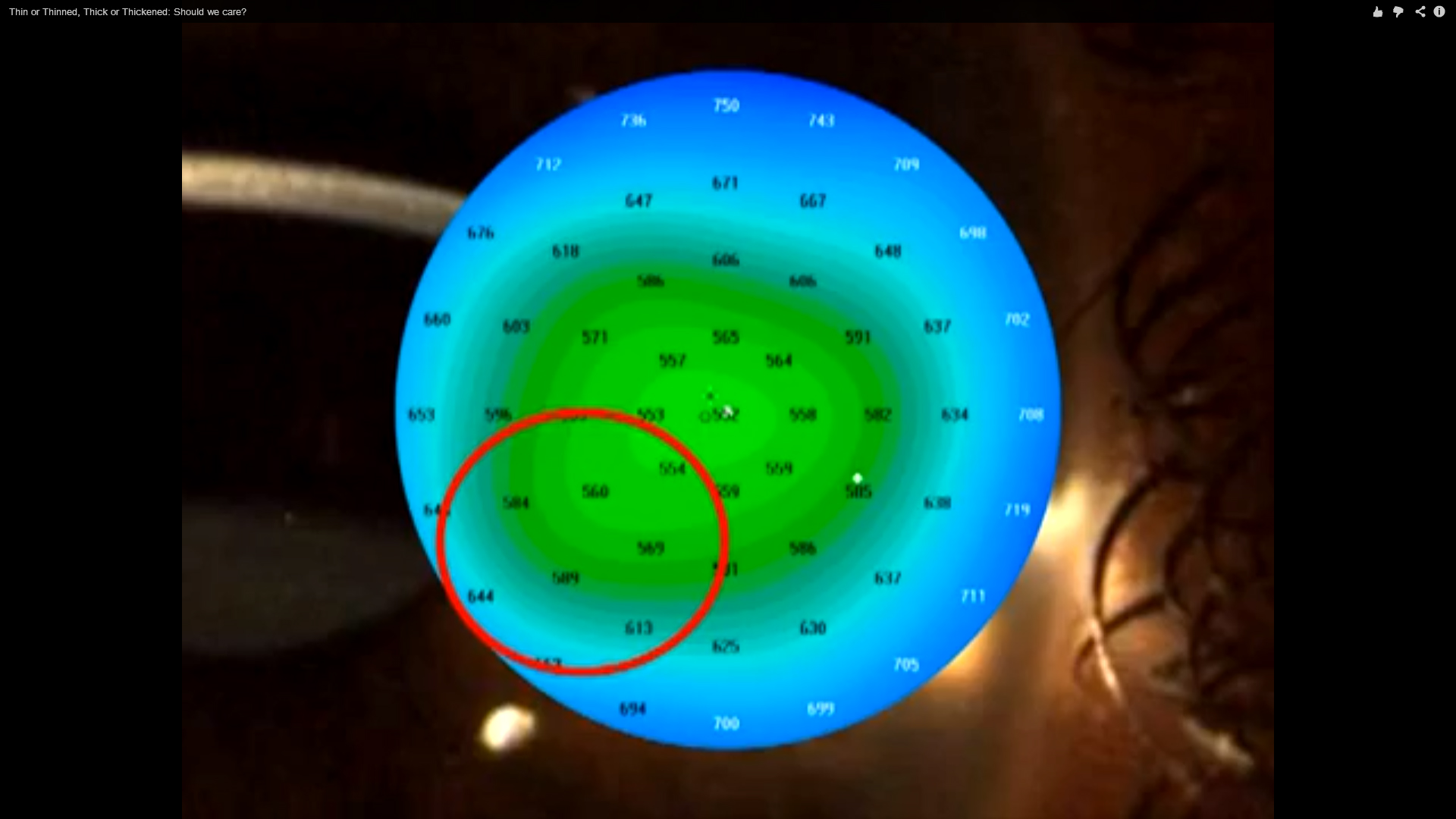 thin-or-thinned-thick-or-thickenedshould-we-care-video2 Foro Refractiva Mejoría refractiva del queratocono con lentes fáquicas