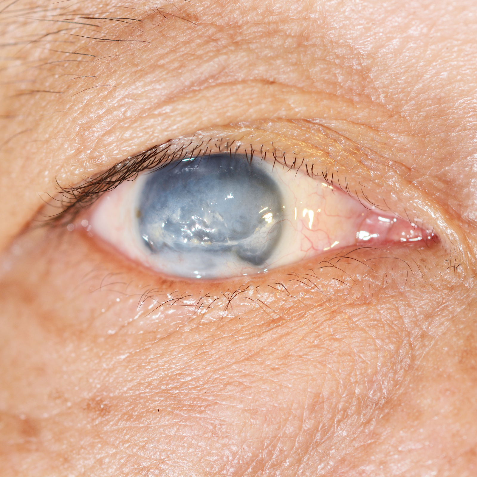 Eye Exam Artículo Especial Cinco datos que todo cirujano de catarata debe saber sobre la retina – Parte 2
