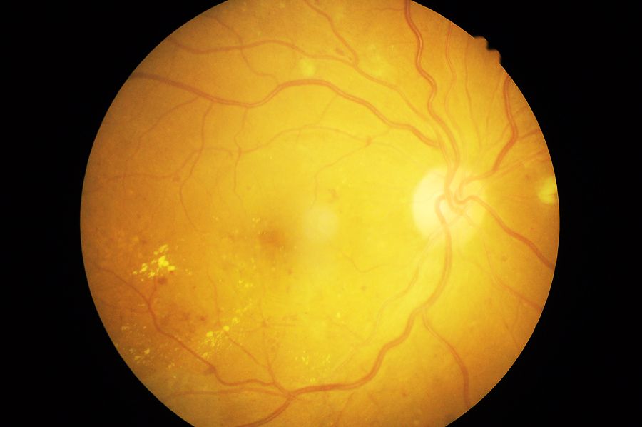 Medical photo of retinal pathology,Disorders of sclera ,cornea , Artículo Especial Cinco datos que todo cirujano de catarata debe saber sobre la retina – Parte 2
