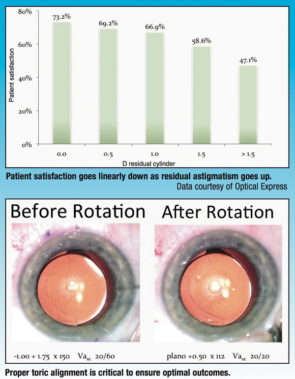 imagen-1 Editorial Catarata: Tecnología Intraoperatoria para mejores resultados refractivos