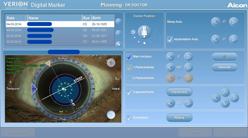 imagen-3 Editorial Catarata: Tecnología Intraoperatoria para mejores resultados refractivos